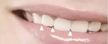 切牙之切外展隙