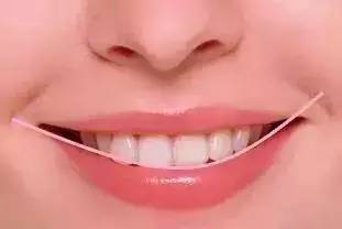 做牙贴面去哪里比较好