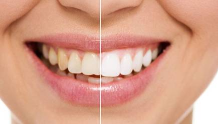 上海美莱冷光美白牙齿