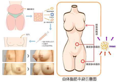 上海美莱自体脂肪丰胸