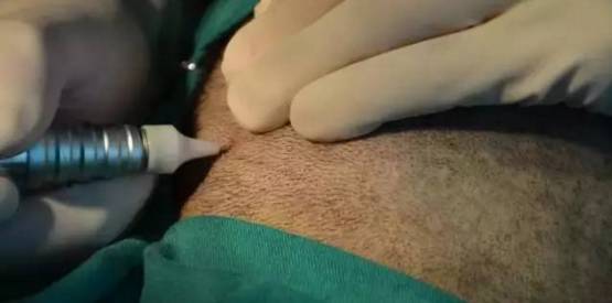 供体毛囊的提取