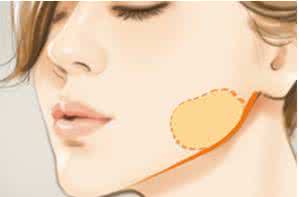 去颊脂垫有副作用吗