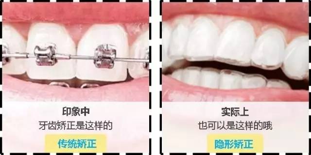 美莱隐形牙齿矫正