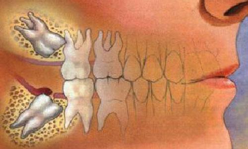 智齿需要拔掉吗