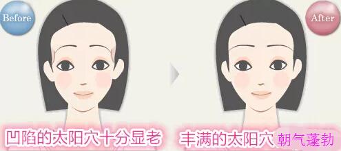 自体脂肪丰太阳穴