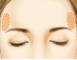 自体脂肪填充太阳穴好吗