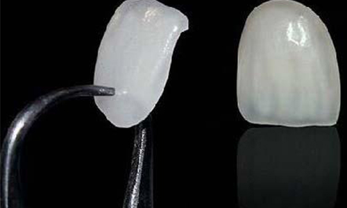 牙贴面美牙