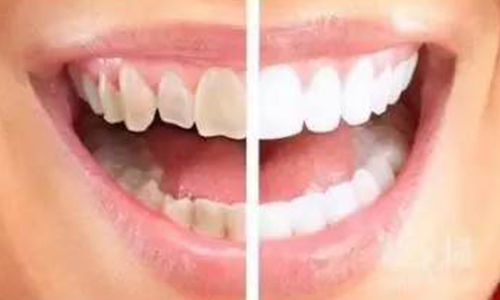 牙齿美白术后注意事项有哪些