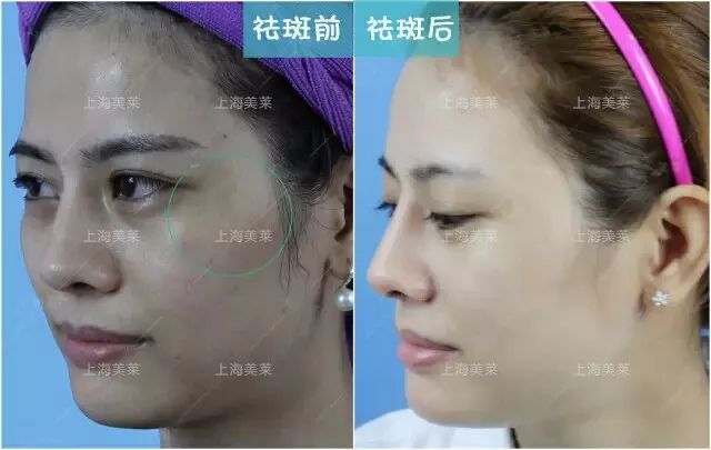 美莱做完激光祛斑后