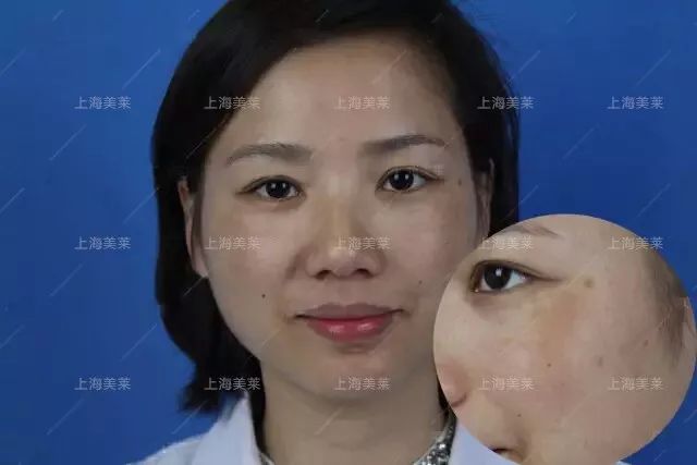 美莱做完激光祛斑后