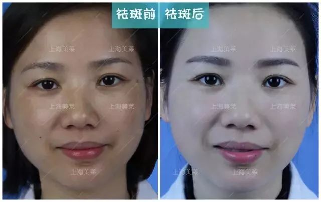蜂巢皮秒祛斑后
