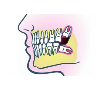 长智齿牙龈肿痛怎么办