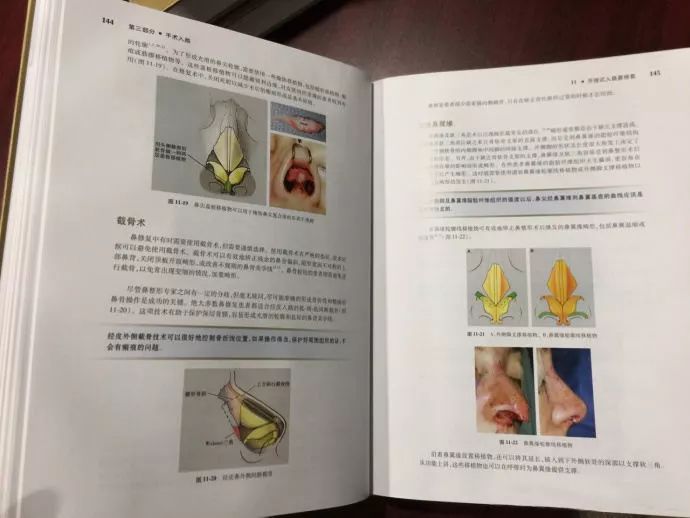 上海美莱李战强教授全新力作《达拉斯鼻修复术》