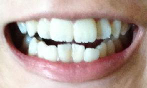 牙齿矫正什么方法好