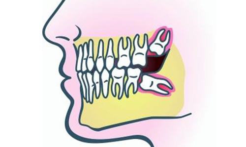 智齿需要全部拔掉吗