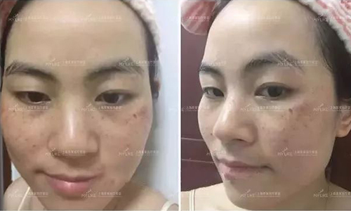 美莱皮秒祛斑