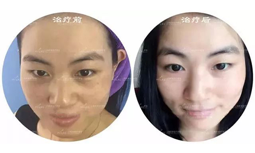 美莱皮秒祛斑对比