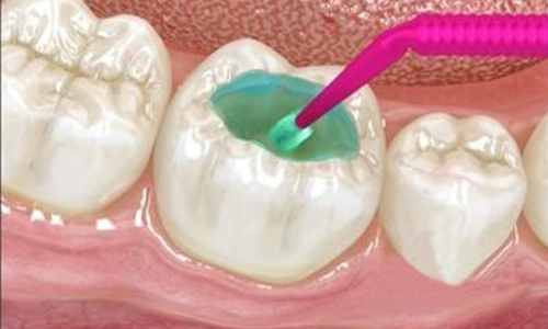 牙齿太敏感怎么办