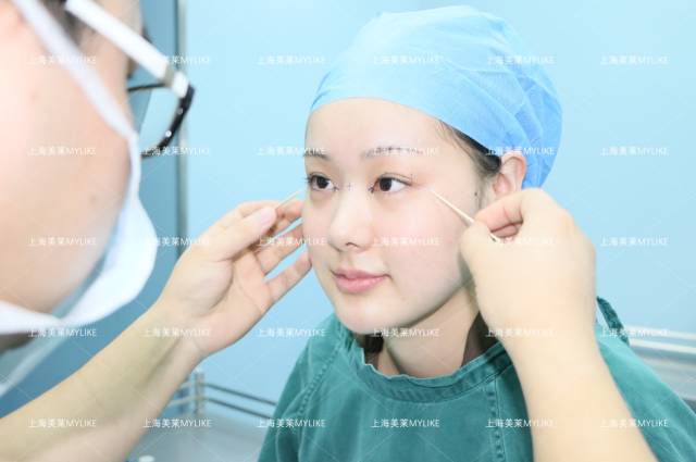 何祥龙双眼皮手术设计