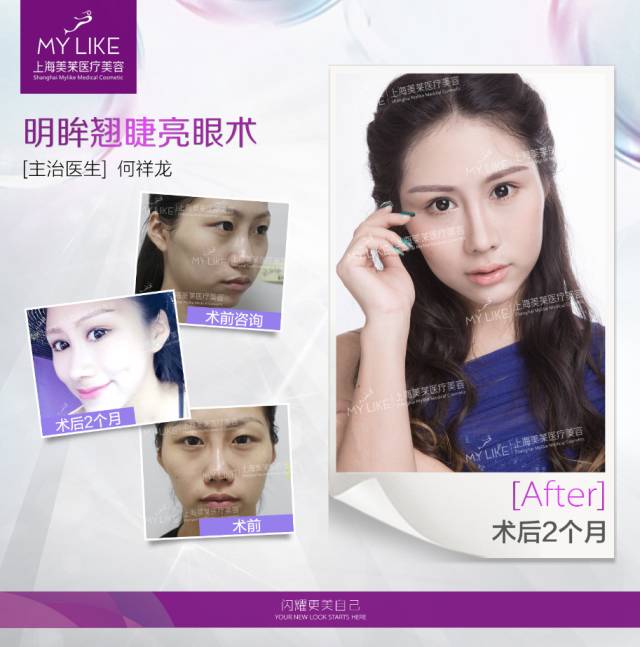 美莱医院双眼皮案例