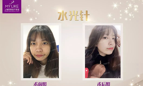 上海美莱水光针补水案例