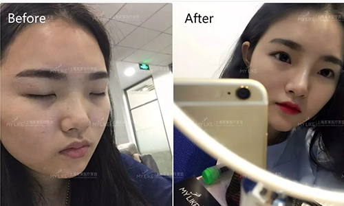 上海美莱玻尿酸案例