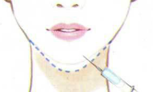 上海注射丰下巴哪家医院好