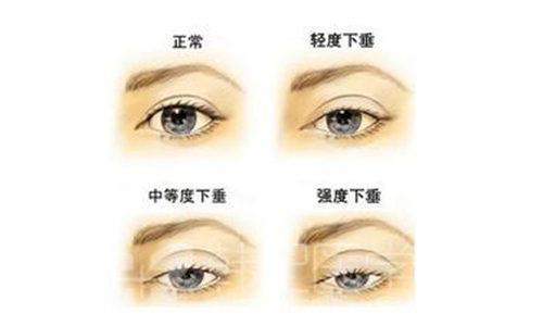 美莱上睑下垂矫正