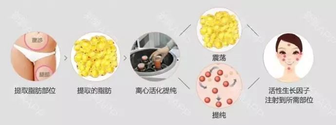 美莱自体脂肪填充