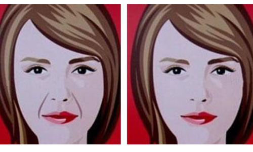 自体脂肪面部填充