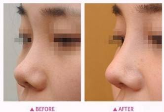 咬肌肥大适合打