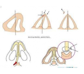 美莱皮秒祛斑过程