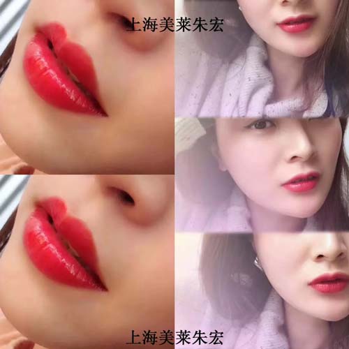 上海美莱线雕隆鼻特惠