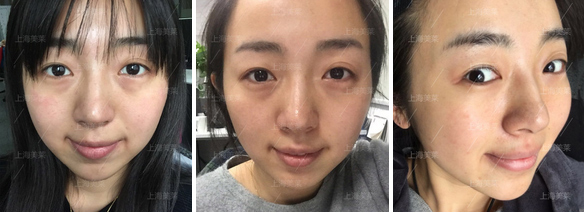 美莱自体脂肪面部填充案例