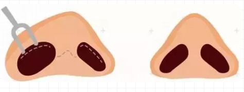 上海美莱假体隆鼻