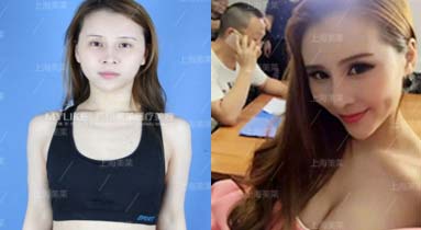 上海美莱医院做双眼皮整形手术