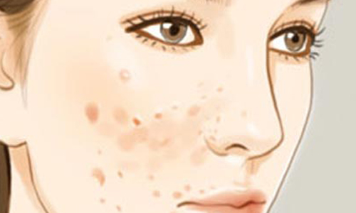 什么是假体隆胸