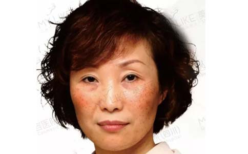 上海美莱玻尿酸注射隆下巴疼不疼