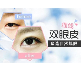 上海做吸脂瘦身费用大概多少钱