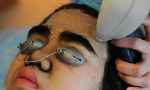 脸上长了晒斑,激光真的可以去掉吗?