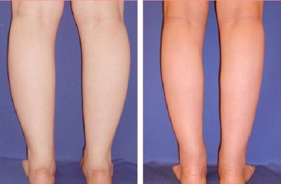 上海美莱化学酸换肤祛痘,做一个精致的女孩