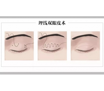 上海激光脱腋毛有作用小