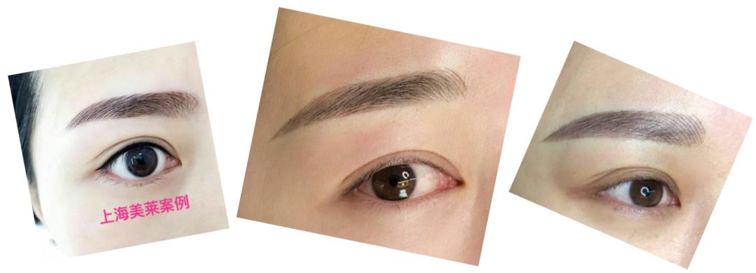 隐形牙套真的能有效矫正牙齿吗