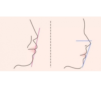 光子嫩肤的功效有哪些，真的有用吗
