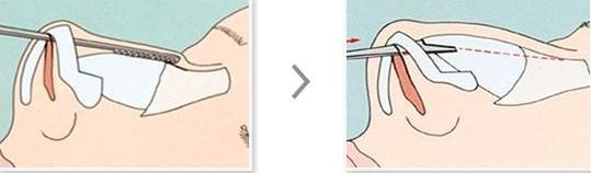 美莱集团鼻整形技术总监李教授