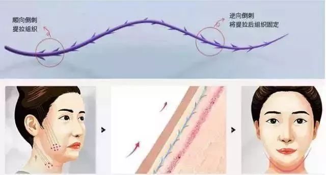 美莱自体脂肪面部填充