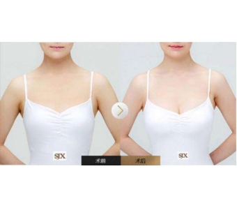 注射玻尿酸除皱安不安全,会留下后遗症吗