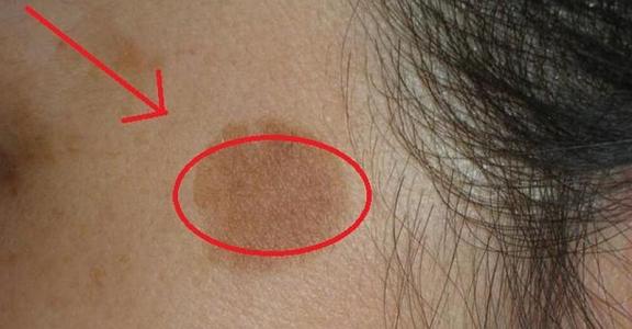 上海美莱眼整形技术指导吴海龙主任