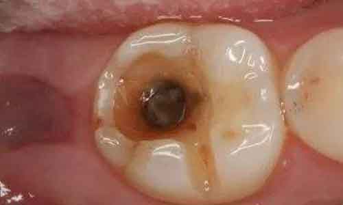 杨锋教授赫林现象在眼整形中的应用