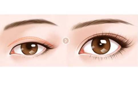 注射丰唇哪家医院好，多少钱